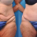 Tummy Tuck #5 - Before and After