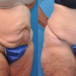 Tummy Tuck #5 - Before and After