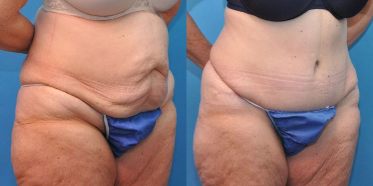 Tummy Tuck #5 - Before and After