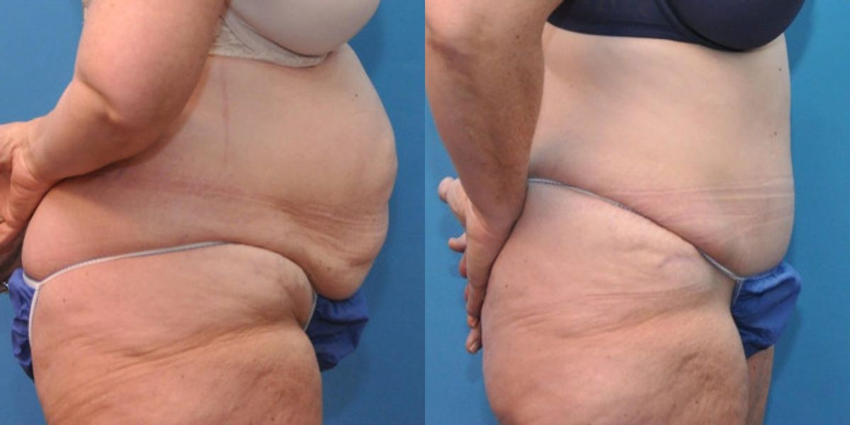 Tummy Tuck #5 - Before and After
