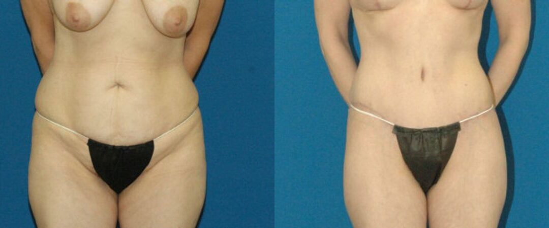 Tummy Tuck #6