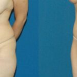 Tummy Tuck #6 - Before and After