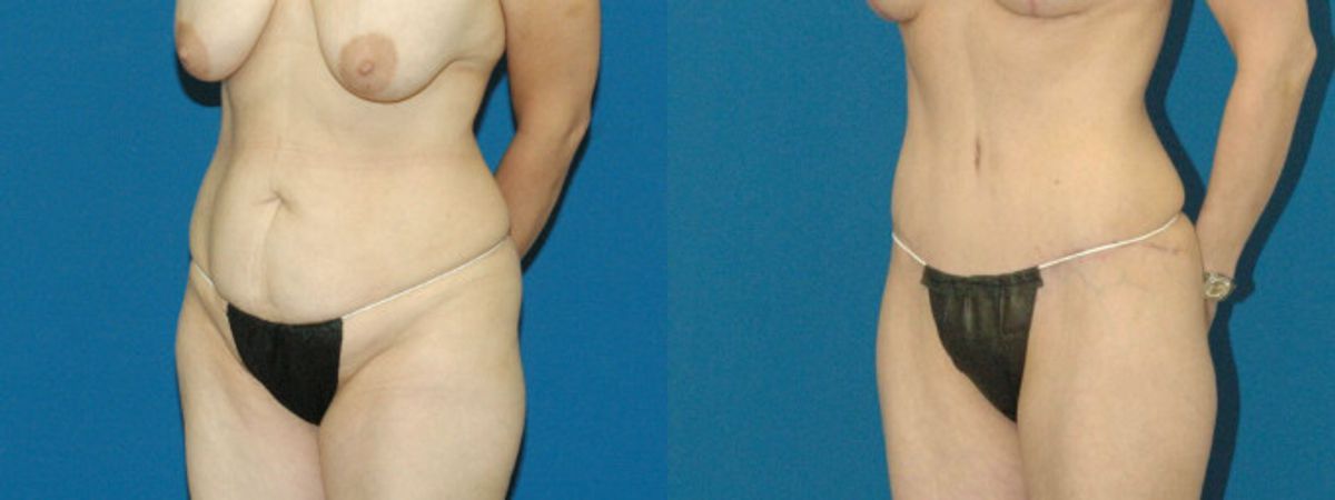 Tummy Tuck #6 - Before and After