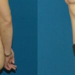 Tummy Tuck #6 - Before and After