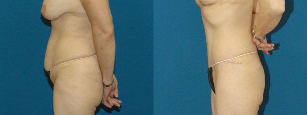 Tummy Tuck #6 - Before and After