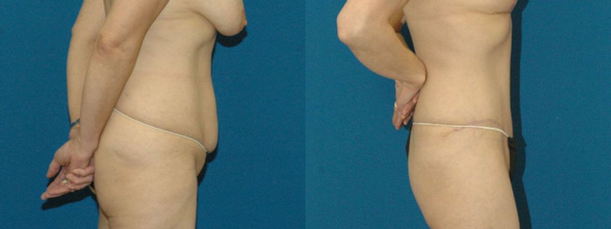 Tummy Tuck #6 - Before and After