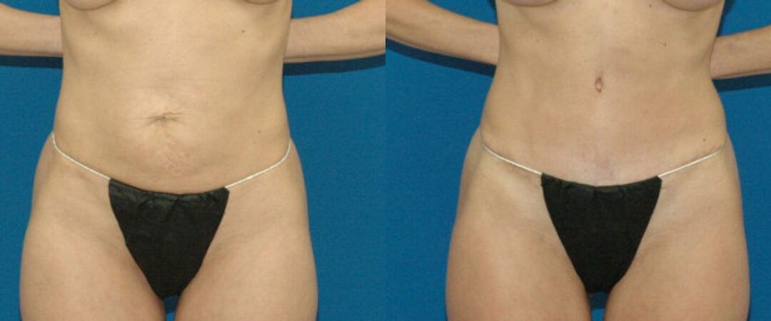 Tummy Tuck #7