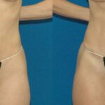 Tummy Tuck #7 - Before and After