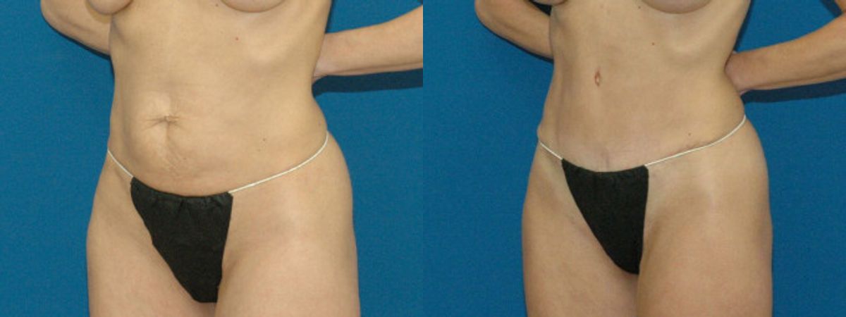Tummy Tuck #7 - Before and After