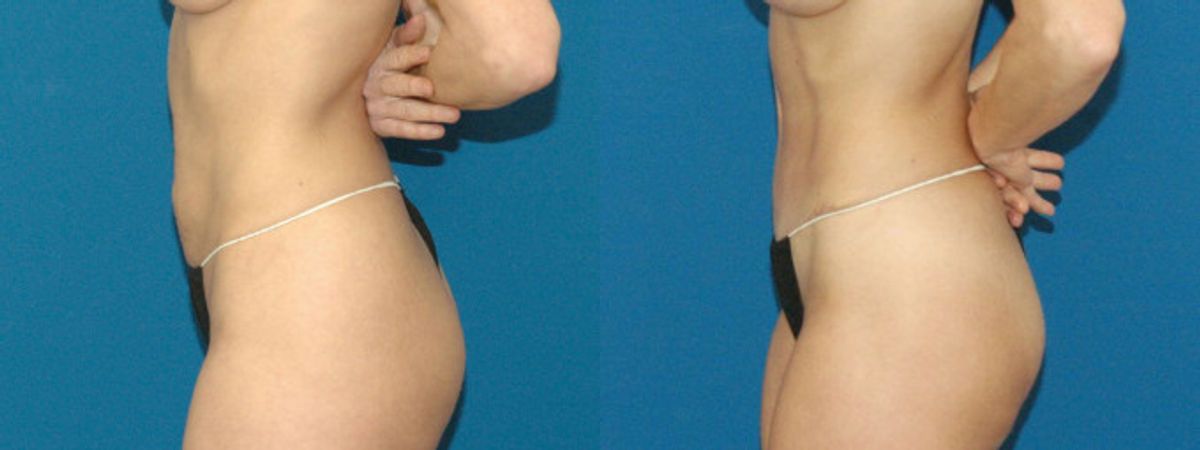 Tummy Tuck #7 - Before and After