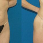 Tummy Tuck #7 - Before and After