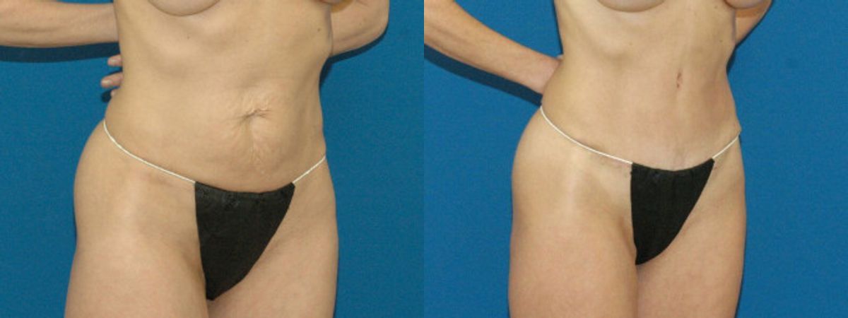 Tummy Tuck #7 - Before and After