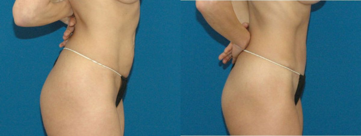 Tummy Tuck #7 - Before and After