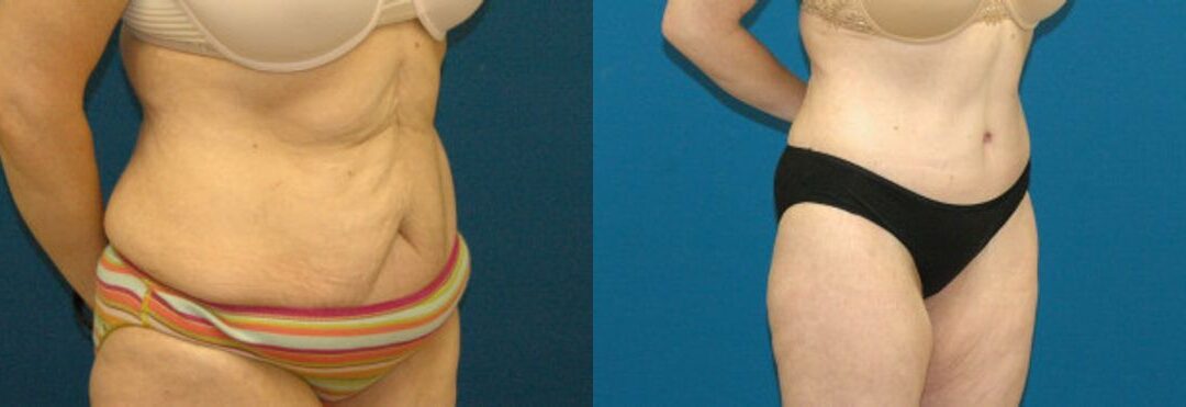 Tummy Tuck #8