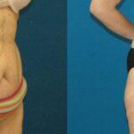 Tummy Tuck #8 - Before and After