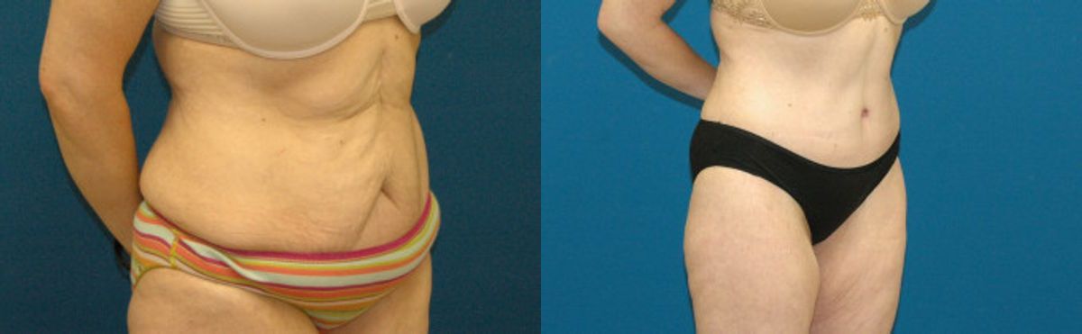 Tummy Tuck #8 - Before and After