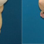 Tummy Tuck #8 - Before and After