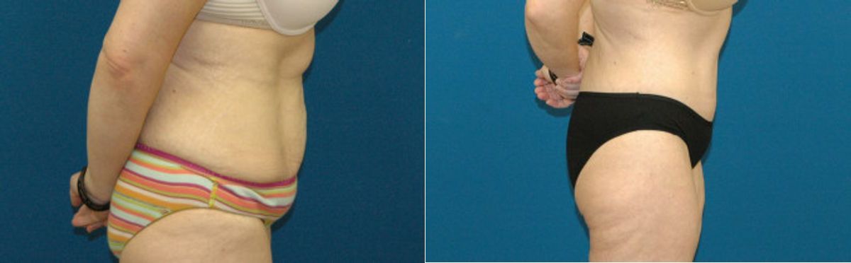 Tummy Tuck #8 - Before and After