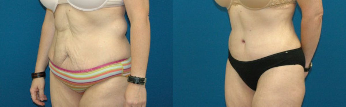 Tummy Tuck #8 - Before and After