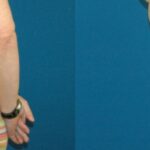 Tummy Tuck #8 - Before and After