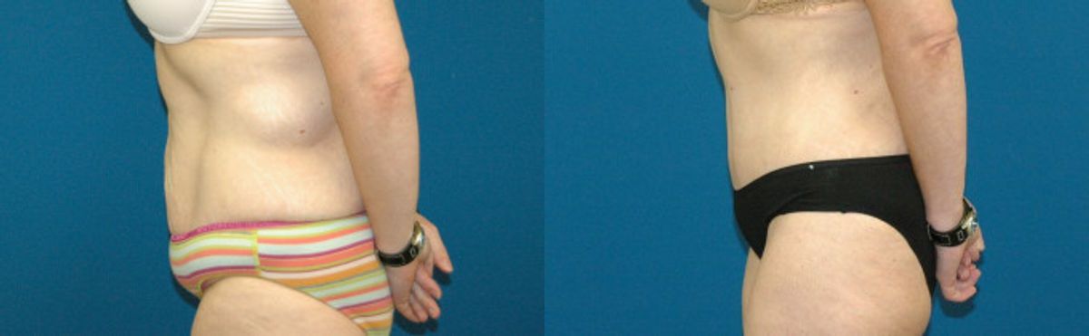 Tummy Tuck #8 - Before and After