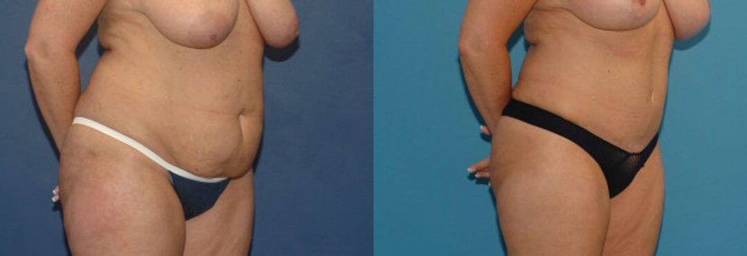 Tummy Tuck #9
