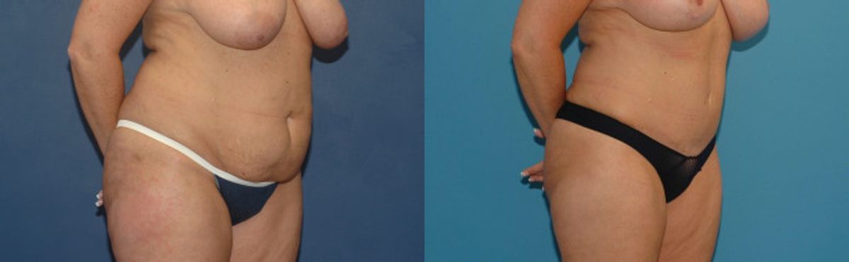 Tummy Tuck #9 - Before and After