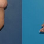 Tummy Tuck #9 - Before and After