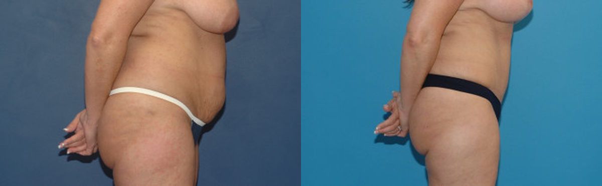 Tummy Tuck #9 - Before and After