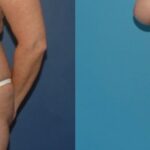 Tummy Tuck #9 - Before and After