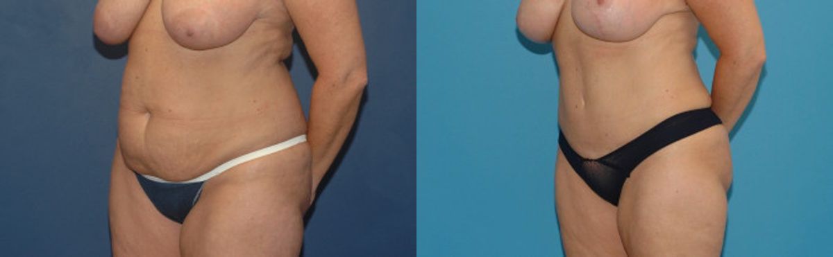 Tummy Tuck #9 - Before and After
