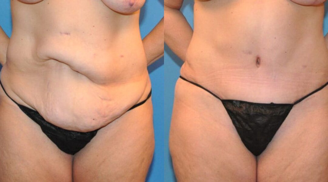 Tummy Tuck #10