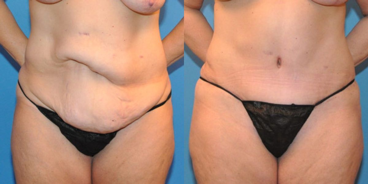 Tummy Tuck #10 - Before and After