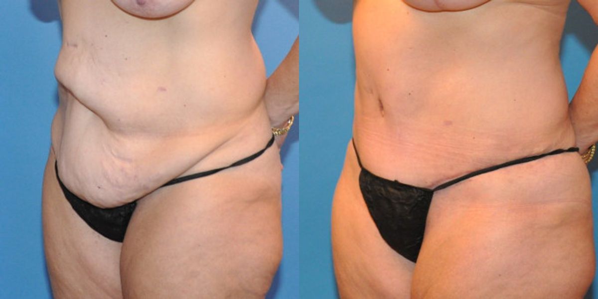 Tummy Tuck #10 - Before and After