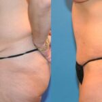 Tummy Tuck #10 - Before and After
