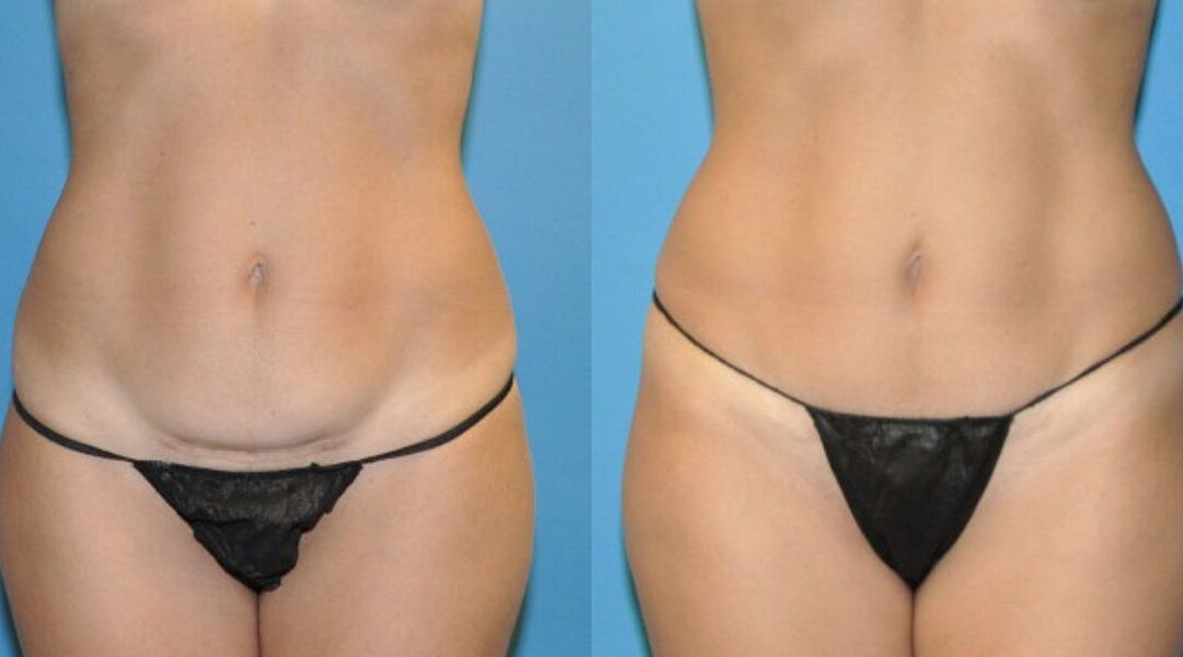 Tummy Tuck (Mini) #11