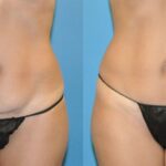 Tummy Tuck (Mini) #11 - Before and After