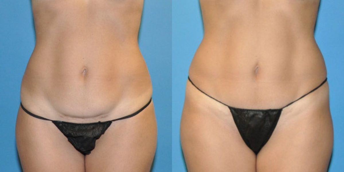 Tummy Tuck (Mini) #11 - Before and After