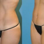 Tummy Tuck (Mini) #11 - Before and After
