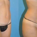 Tummy Tuck (Mini) #11 - Before and After