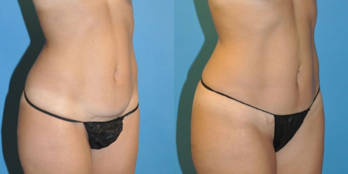 Tummy Tuck (Mini) #11 - Before and After