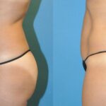 Tummy Tuck (Mini) #11 - Before and After