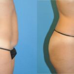 Tummy Tuck (Mini) #11 - Before and After
