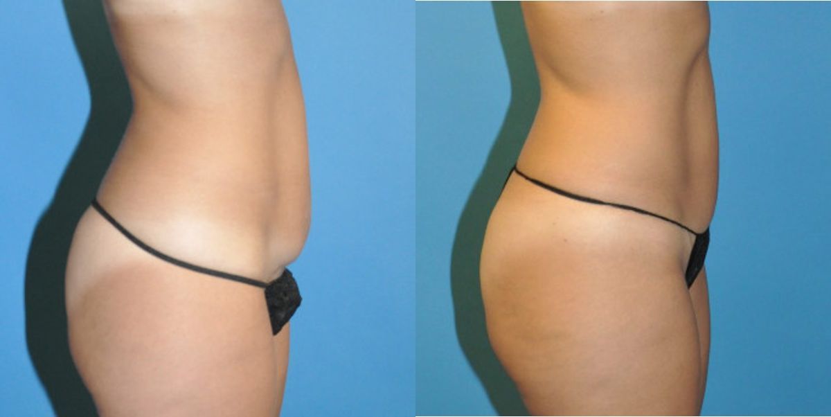 Tummy Tuck (Mini) #11 - Before and After