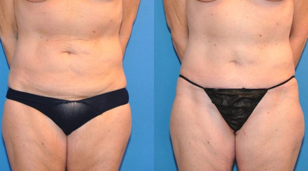 Tummy Tuck (Mini) #12