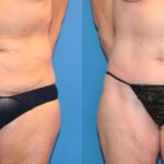 Tummy Tuck (Mini) #12 - Before and After