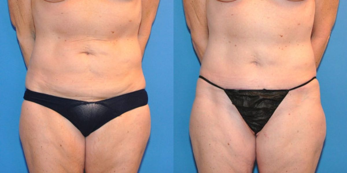 Tummy Tuck (Mini) #12 - Before and After