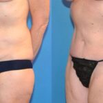 Tummy Tuck (Mini) #12 - Before and After