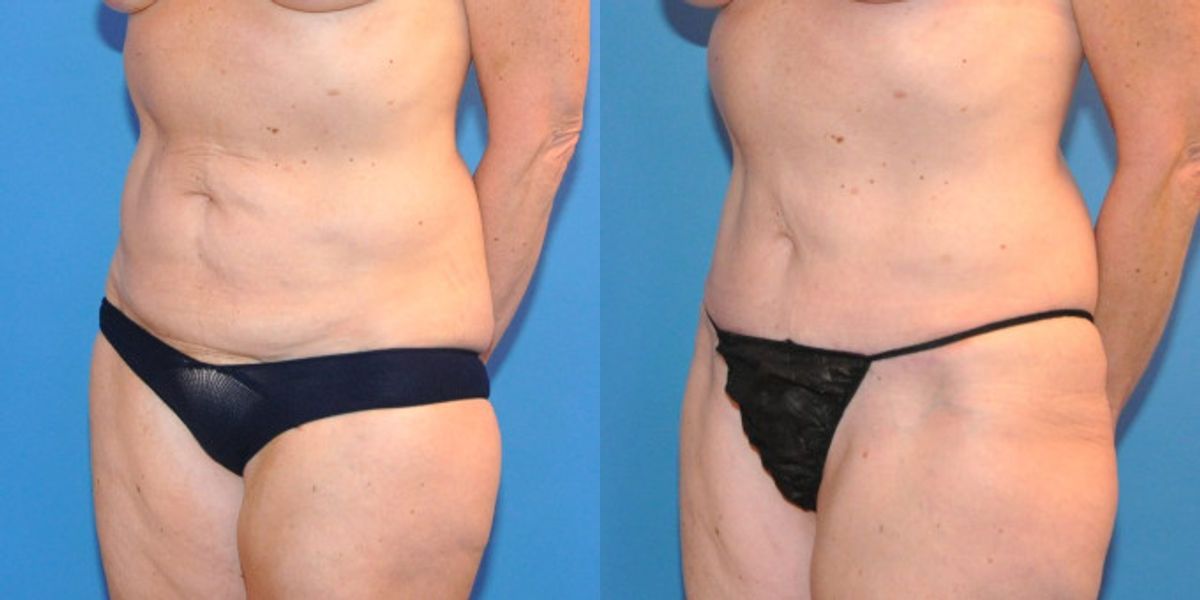 Tummy Tuck (Mini) #12 - Before and After