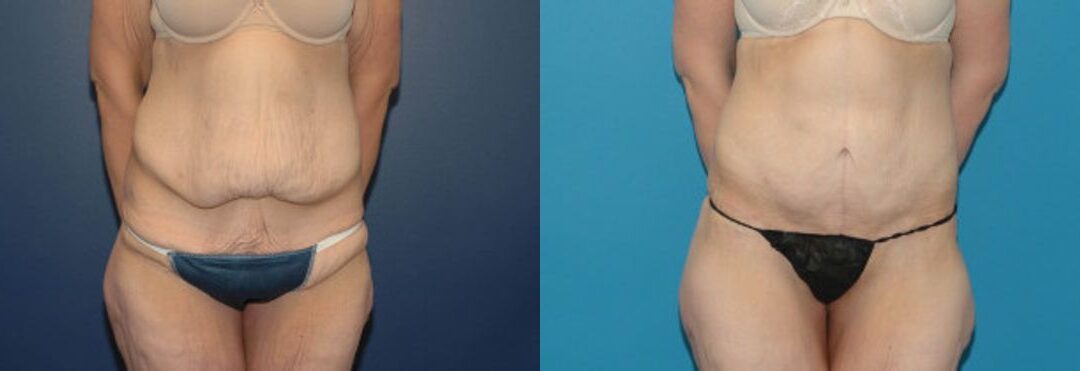 Tummy Tuck #13